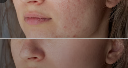 Chemical Peels help with Acne Marks
