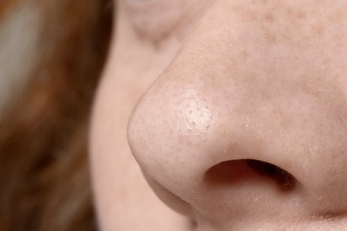 Remove whiteheads from the nose.