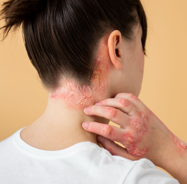 Seborrheic Dermatitis - Treatment, Causes, Symptoms
