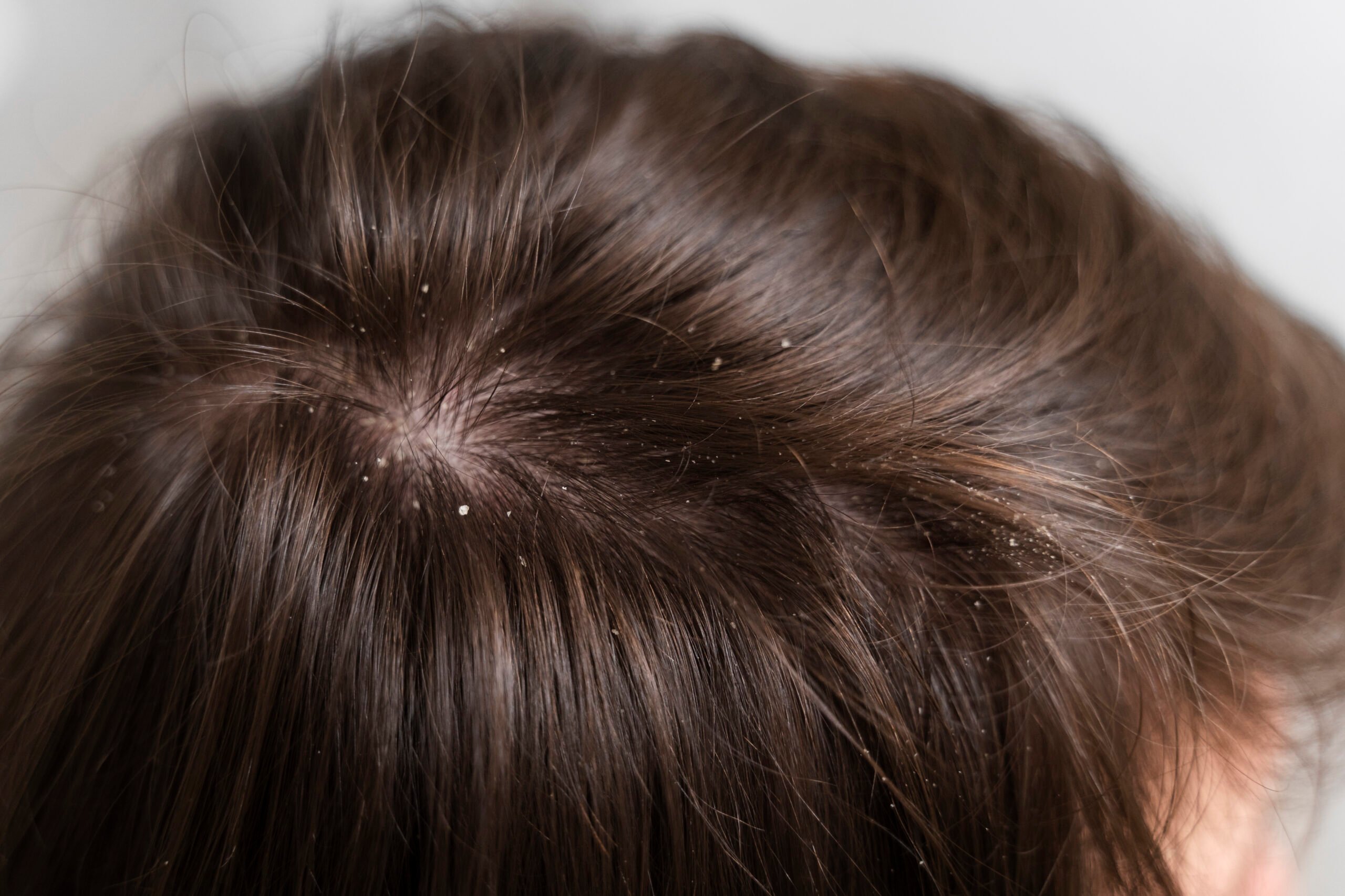 How to Get Rid of Dandruff , Bodycraft