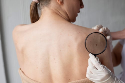 process to remove skin tags