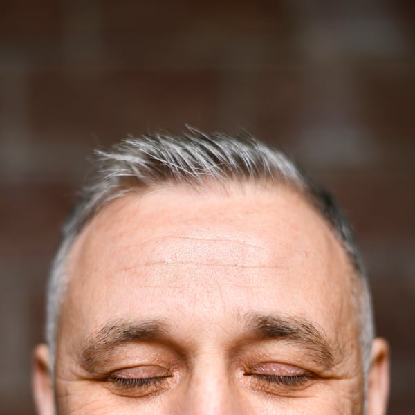 what causes receding hairline