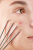 Skin care mistakes - Popping your pimples