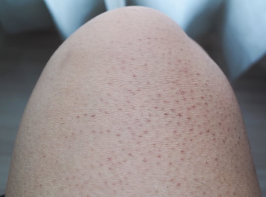 how to get rid of ingrown hair