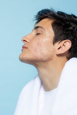 Symptoms of Melasma