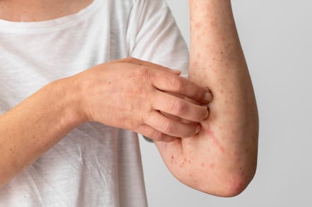 how to remove chicken pox marks