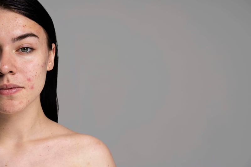 What is a Chemical Peel Treatment for Acne?