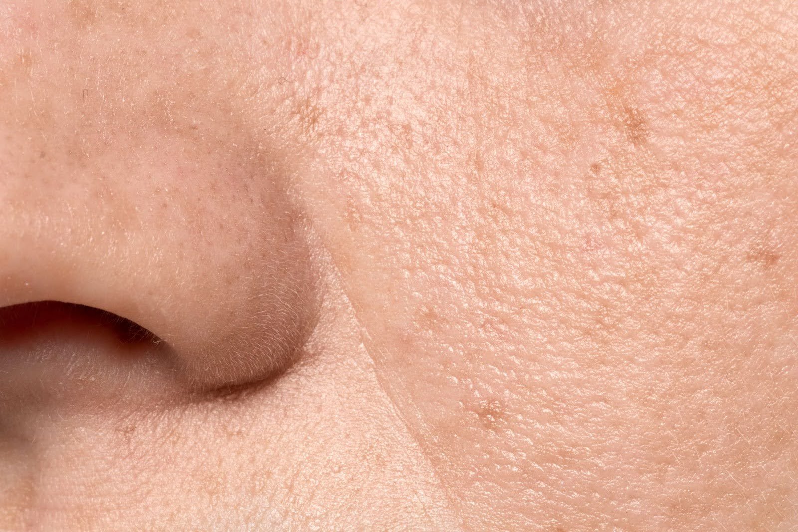 large-open-pores-causes