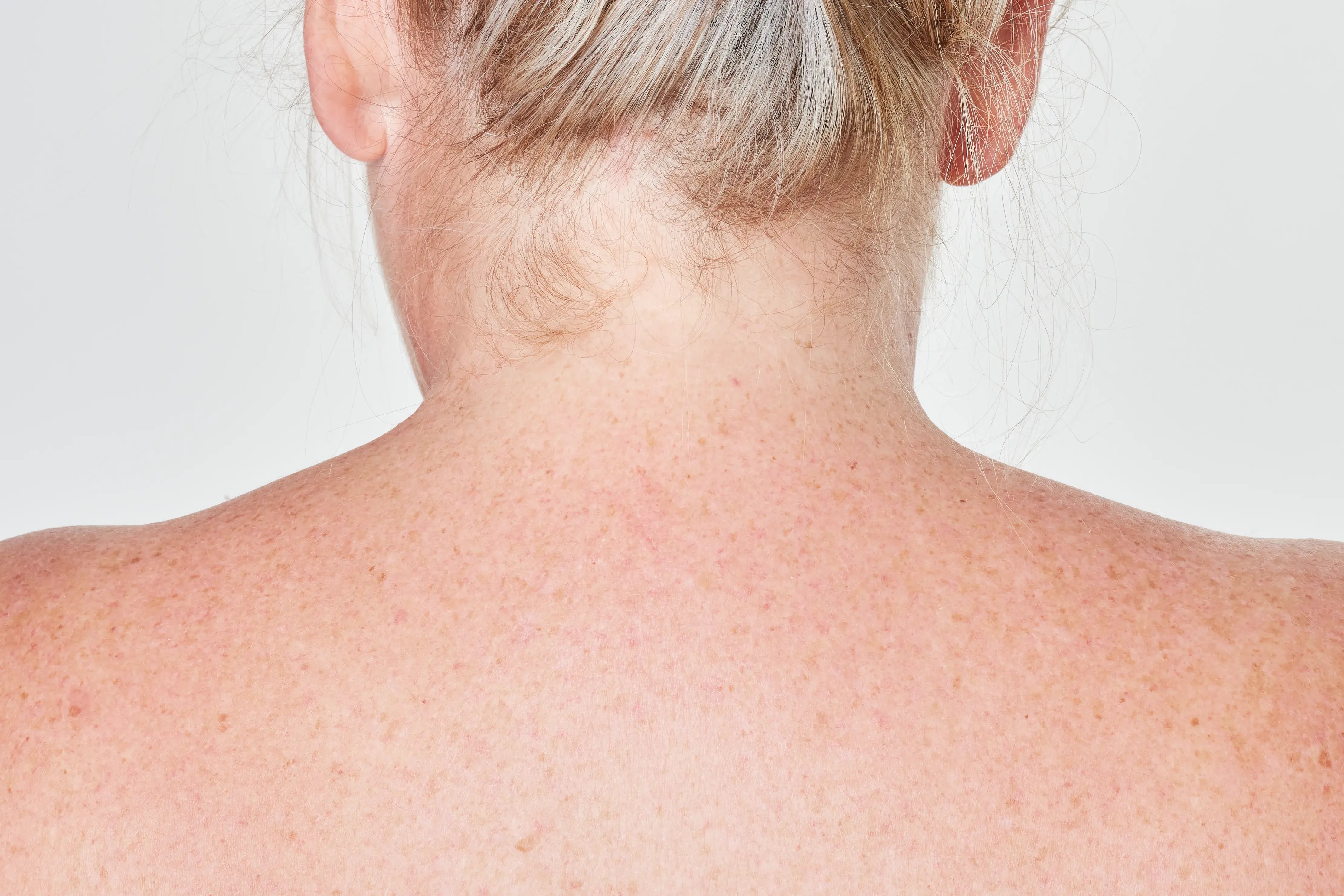 light-skin-back-freckles-complexion-closeup-shot