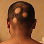Alopecia