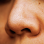 Blackheads, Whiteheads