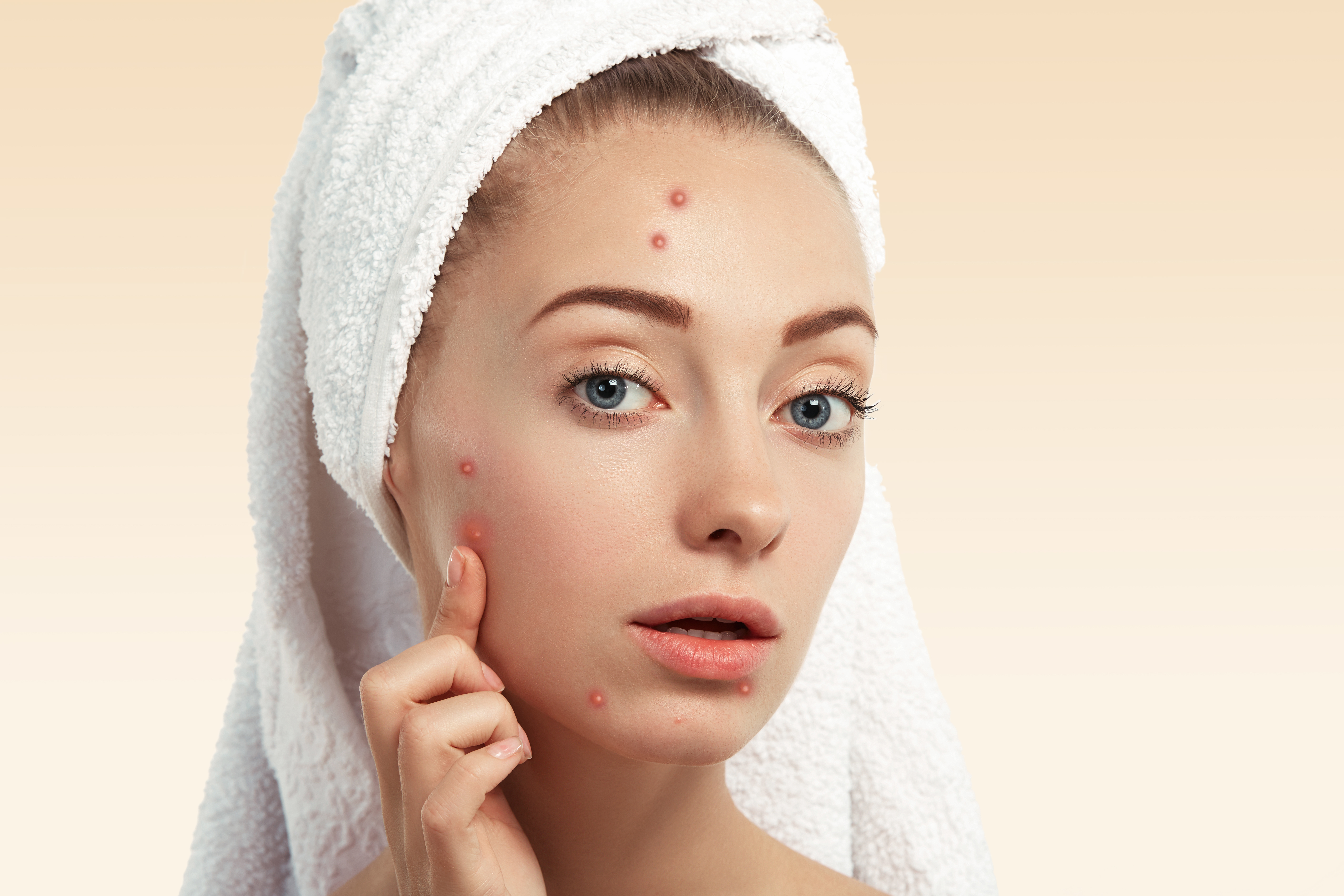 Acne scars on face