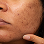 Hyperpigmentation & darkspot