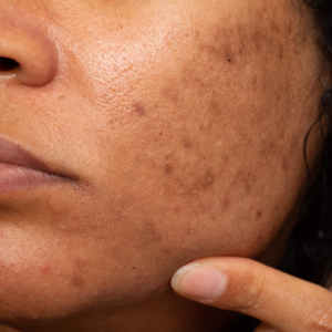 Hyperpigmentation & dark spot