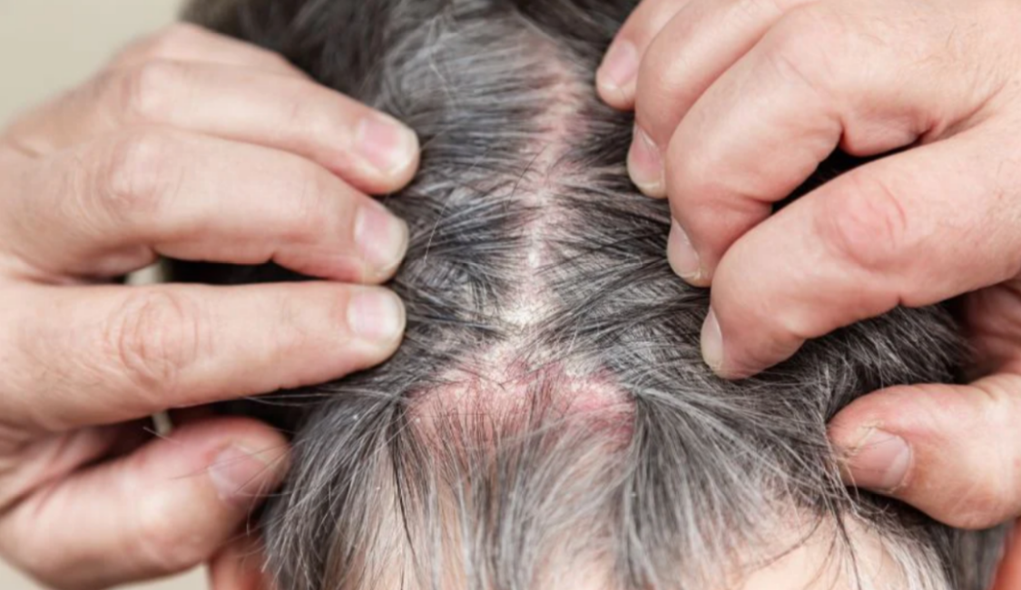 Scalp Folliculitis- Types, Causes, and Treatments