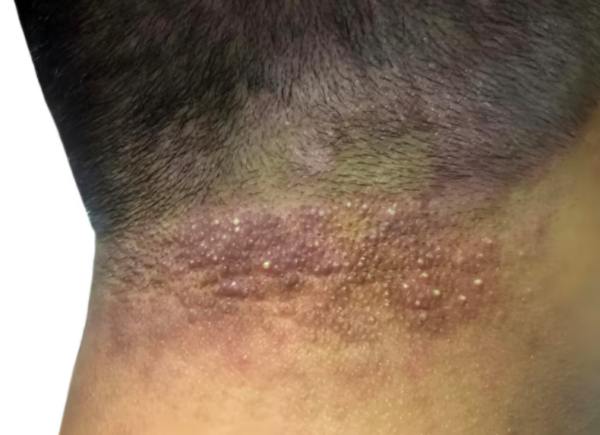 Seborrheic dermatitis on neck