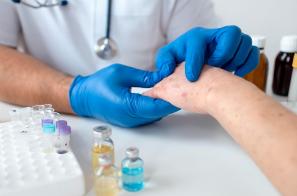 Treating seborrheic dermatitis