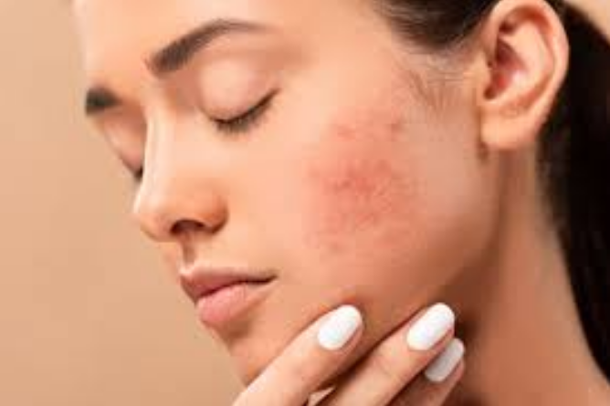 Blemishes on Face: How to Treat Them?