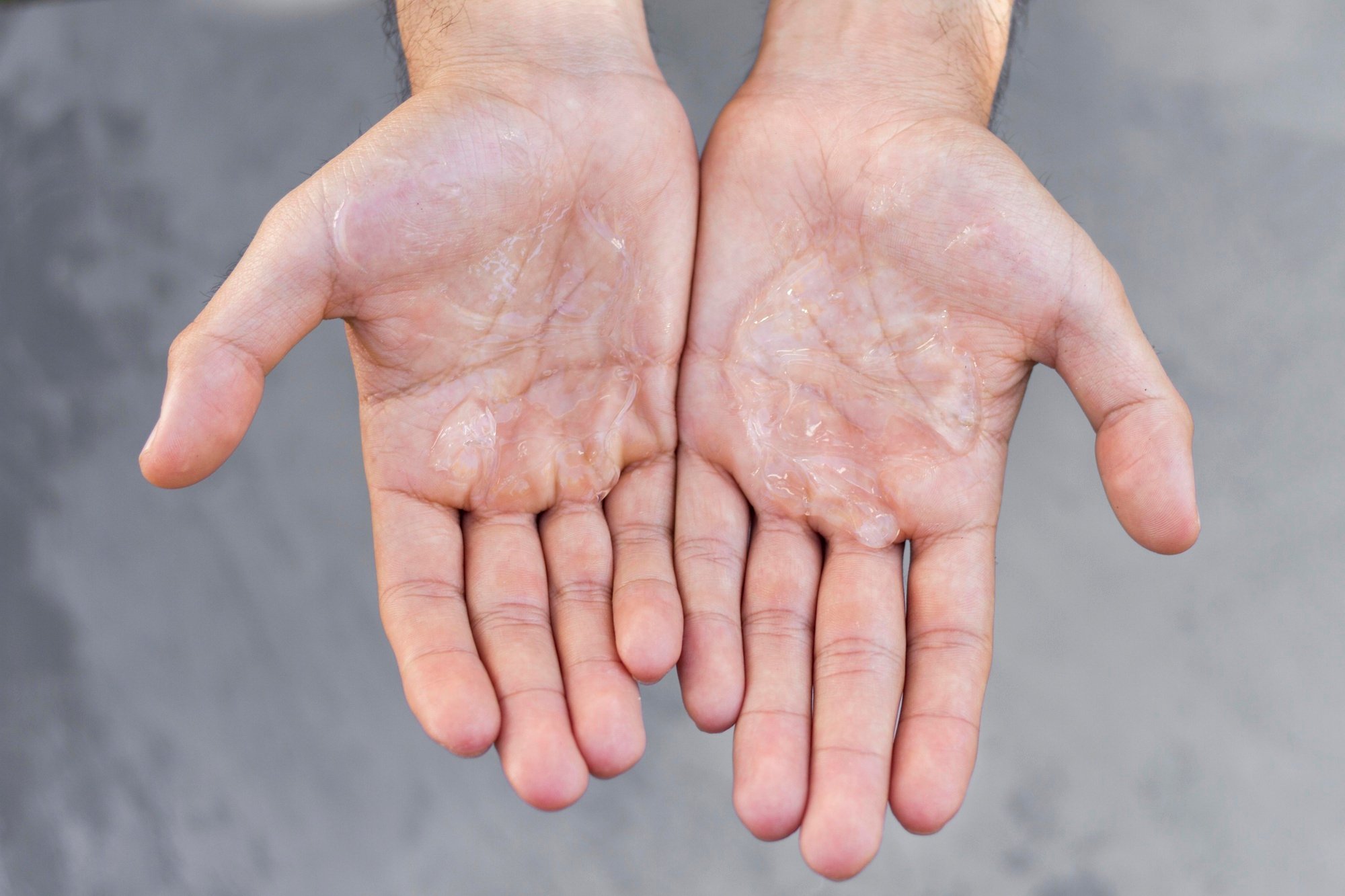 Skin Peeling On Hands: Causes, Treatments & Prevention