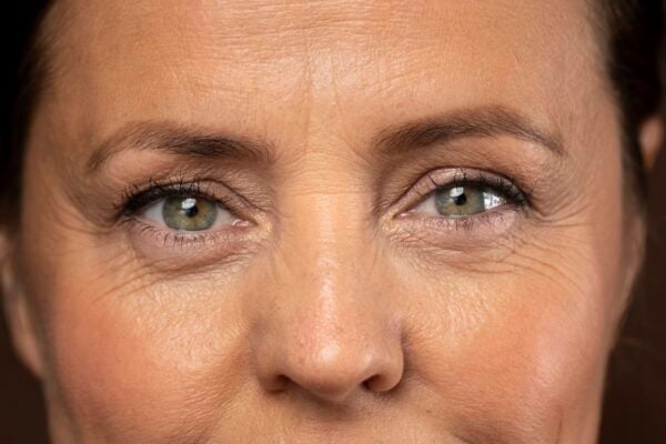 reasons for bags under eye