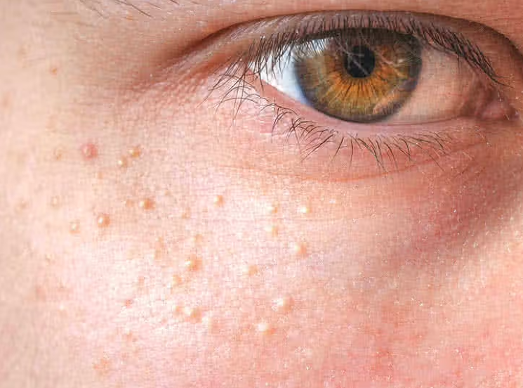 How to Get Rid of Milia (Milk Spots) on the Face?