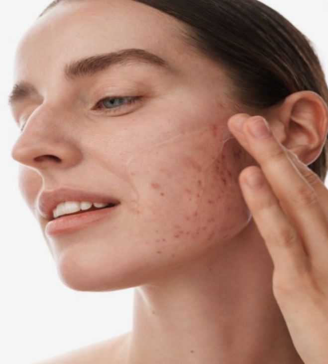 Nodular Acne: Causes and How to Treat It