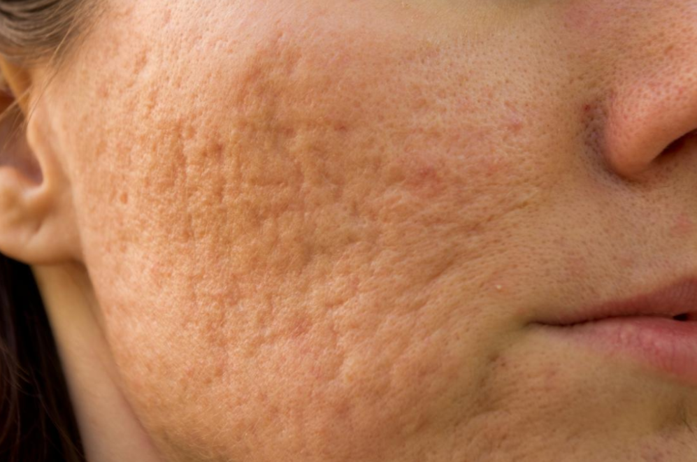 Pockmarks on the Face: Causes and How to Treat Them