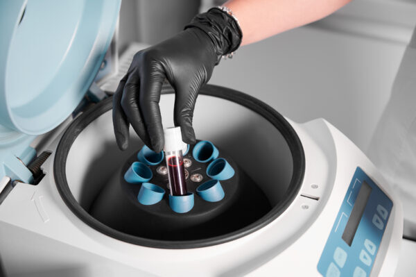 platelet rich plasma face treatment