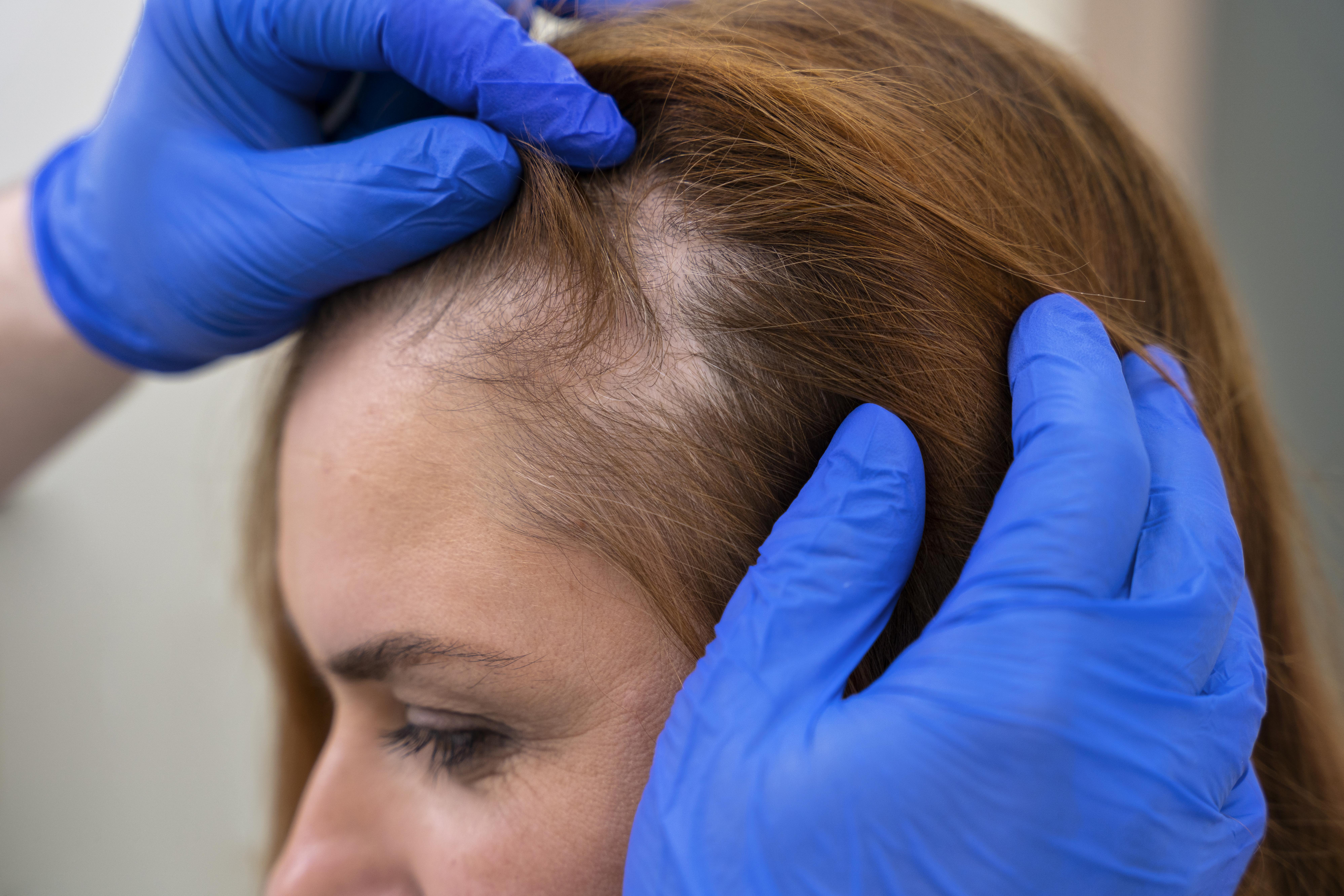 Hair Loss: Types, Causes, Symptoms & Treatments