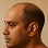 Receding Hairline