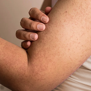 Strawberry skin (Keratosis pilaris)