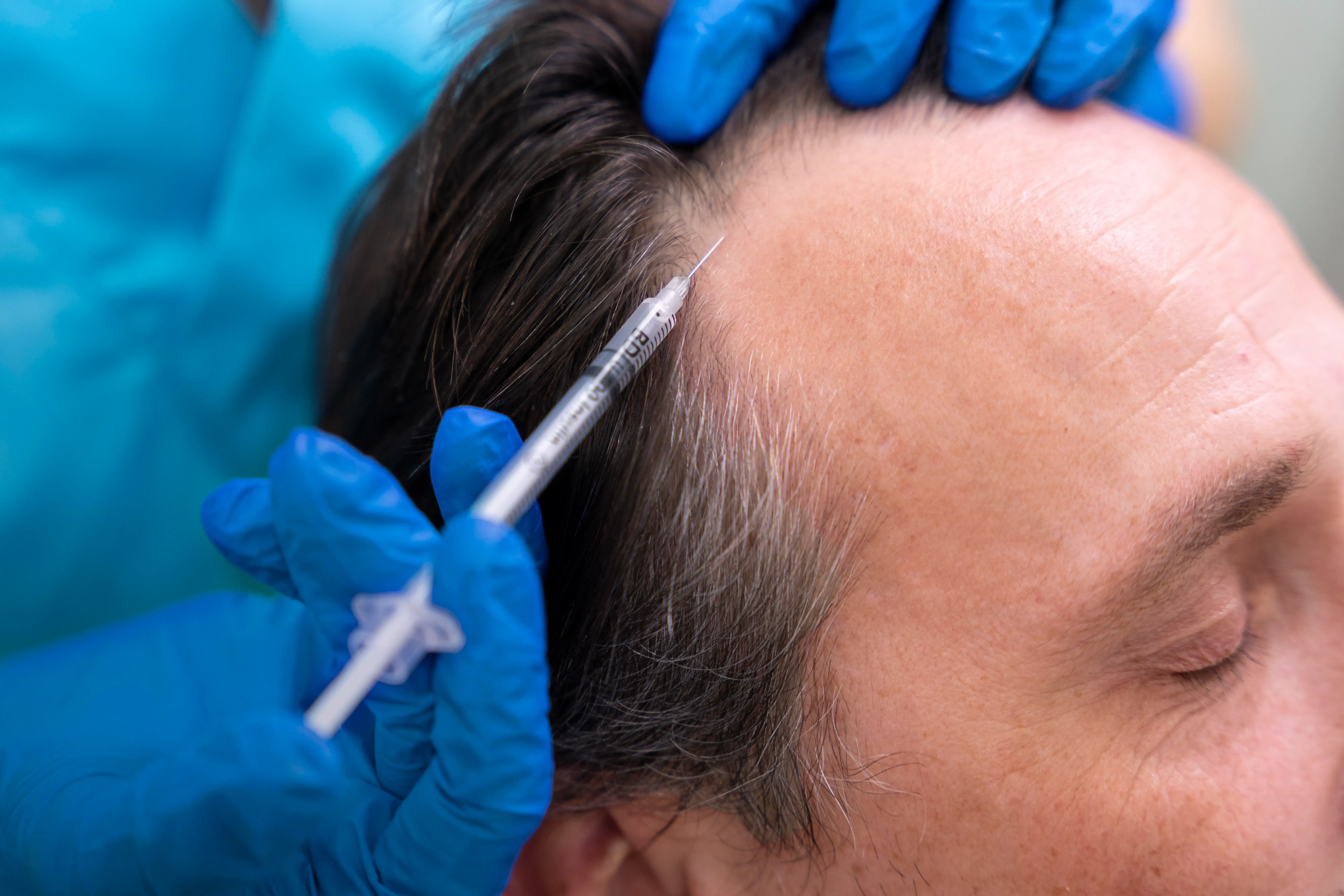 What Is Non-Surgical Hair Replacement? Complete Guide