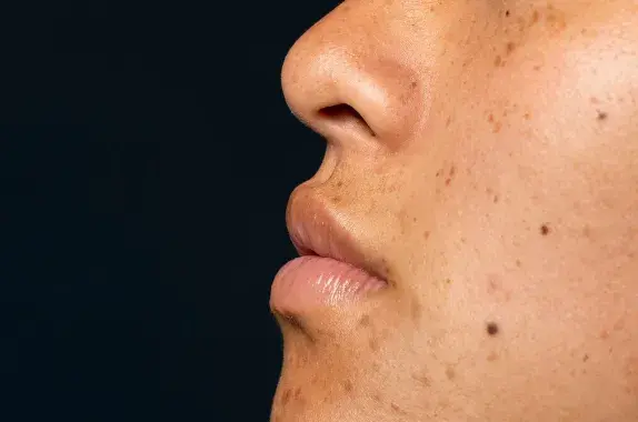 Can Stress Cause Dark Spots on Skin​