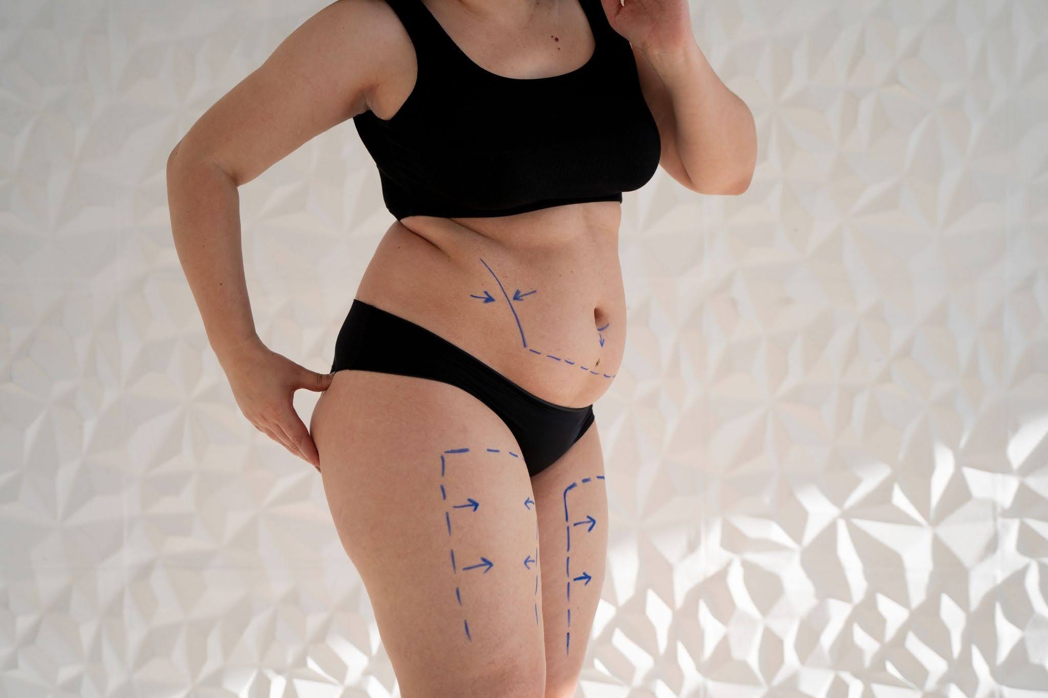 Does Fat Come Back After a Tummy Tuck? Explained