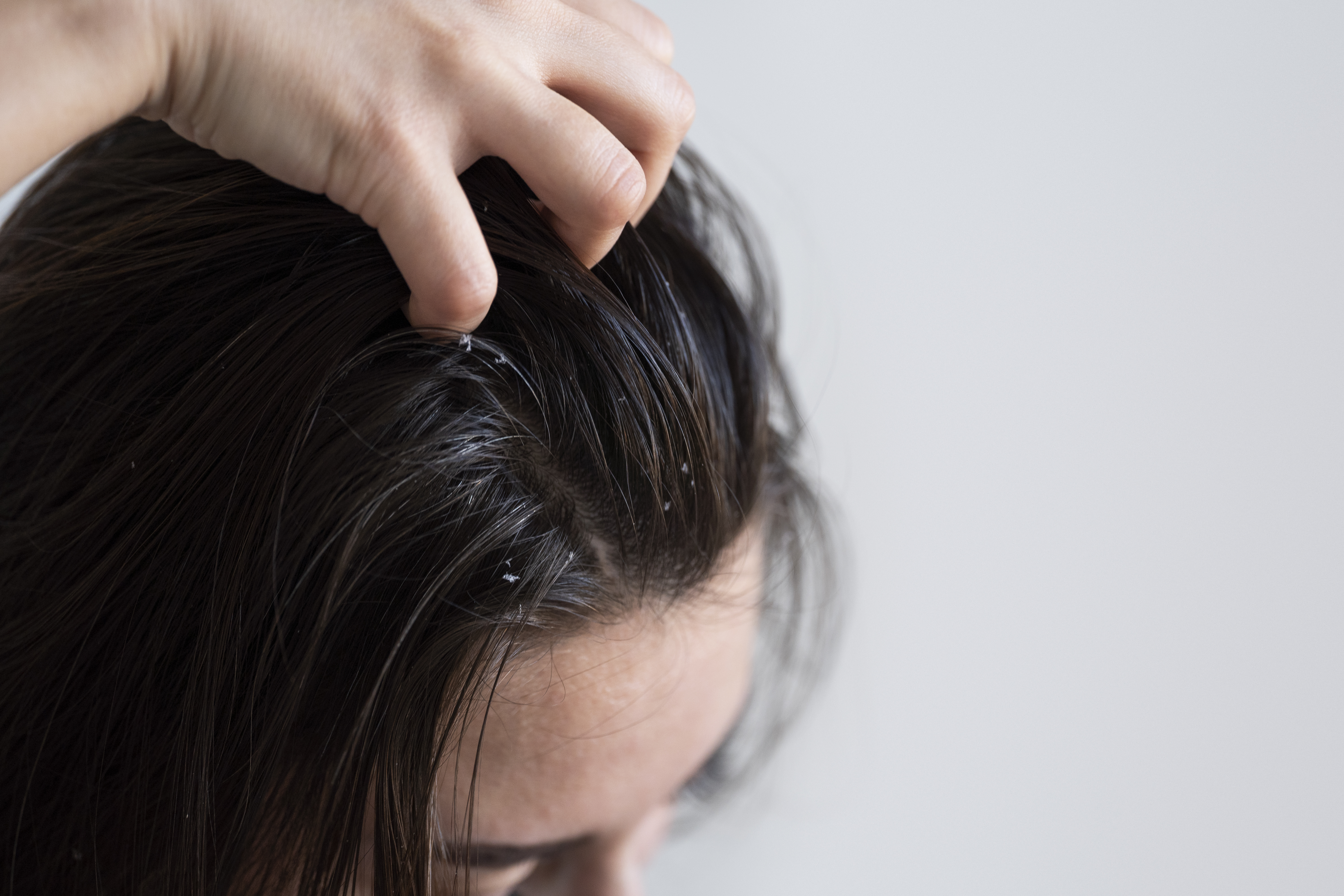 Malassezia Scalp Treatment: Managing Fungal Dandruff, Itching & Scalp Inflammation