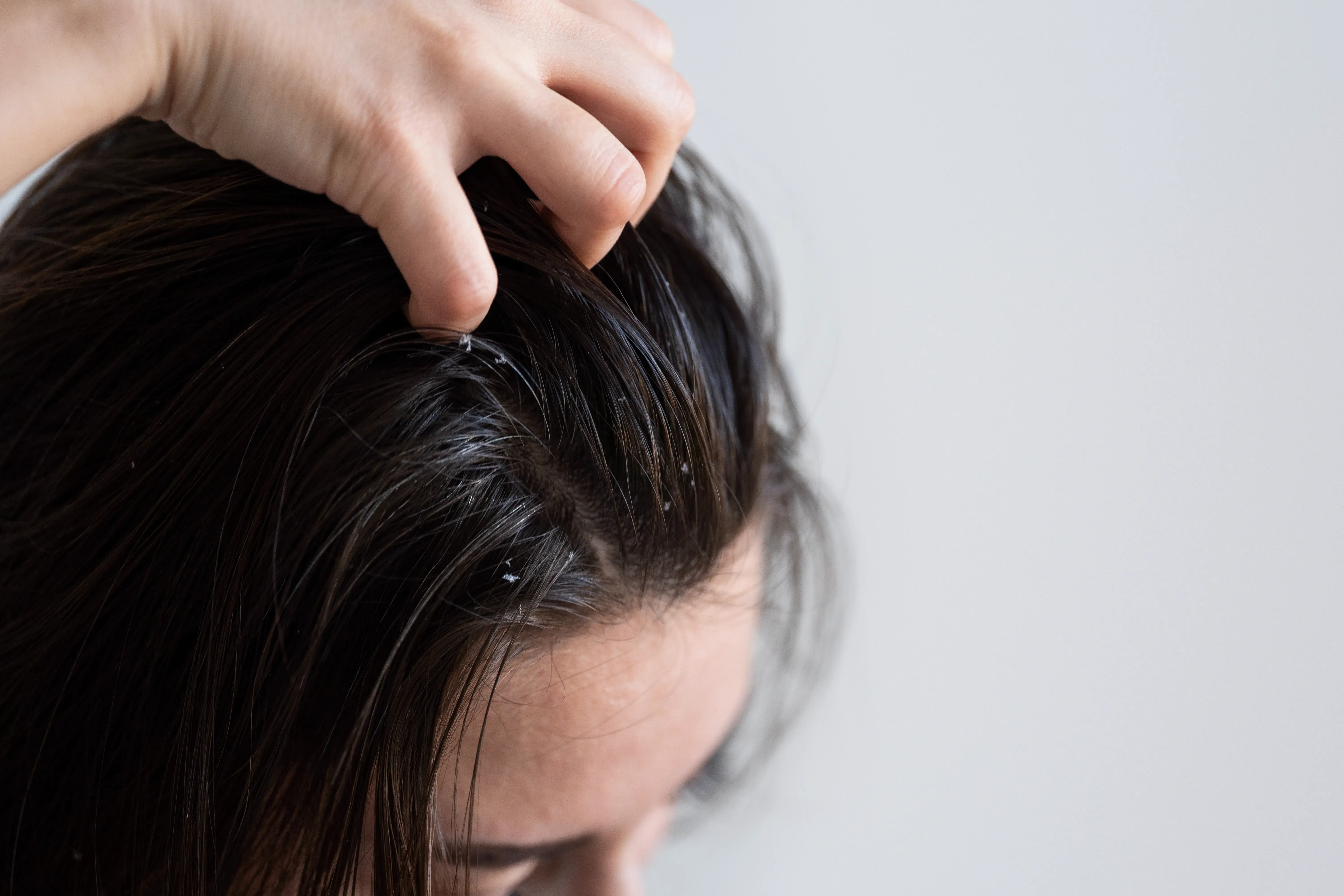 Can Stress Cause an Itchy Scalp?