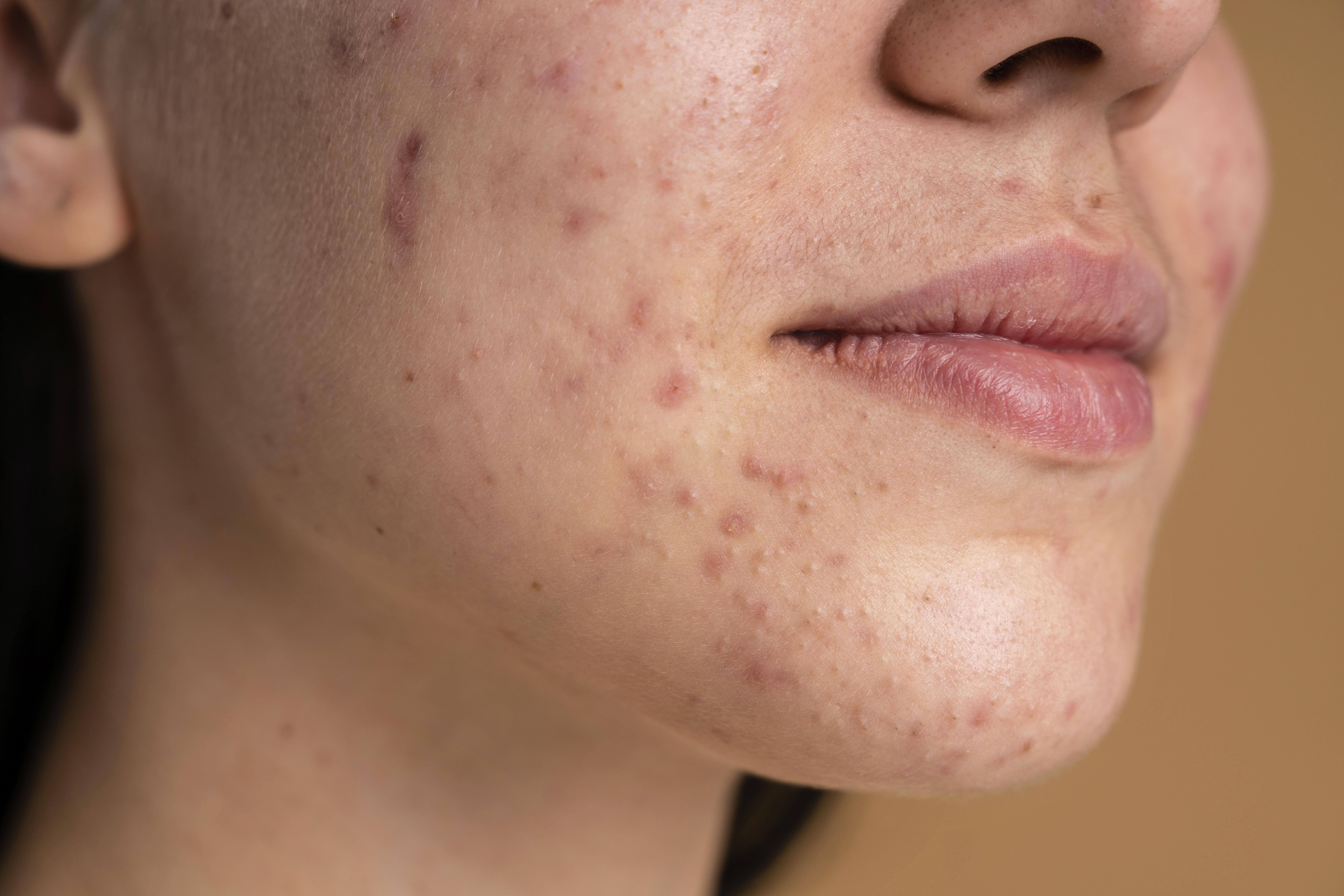 How to Treat Fungal Acne on Face: A Dermatologist's Step-by-Step Guide