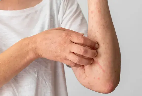 Truncal Acne: Why Your Body Breaks Out (And What Can Help)