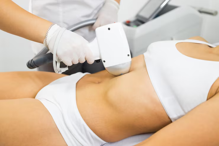 How Effective is Laser Lipo? What to Expect
