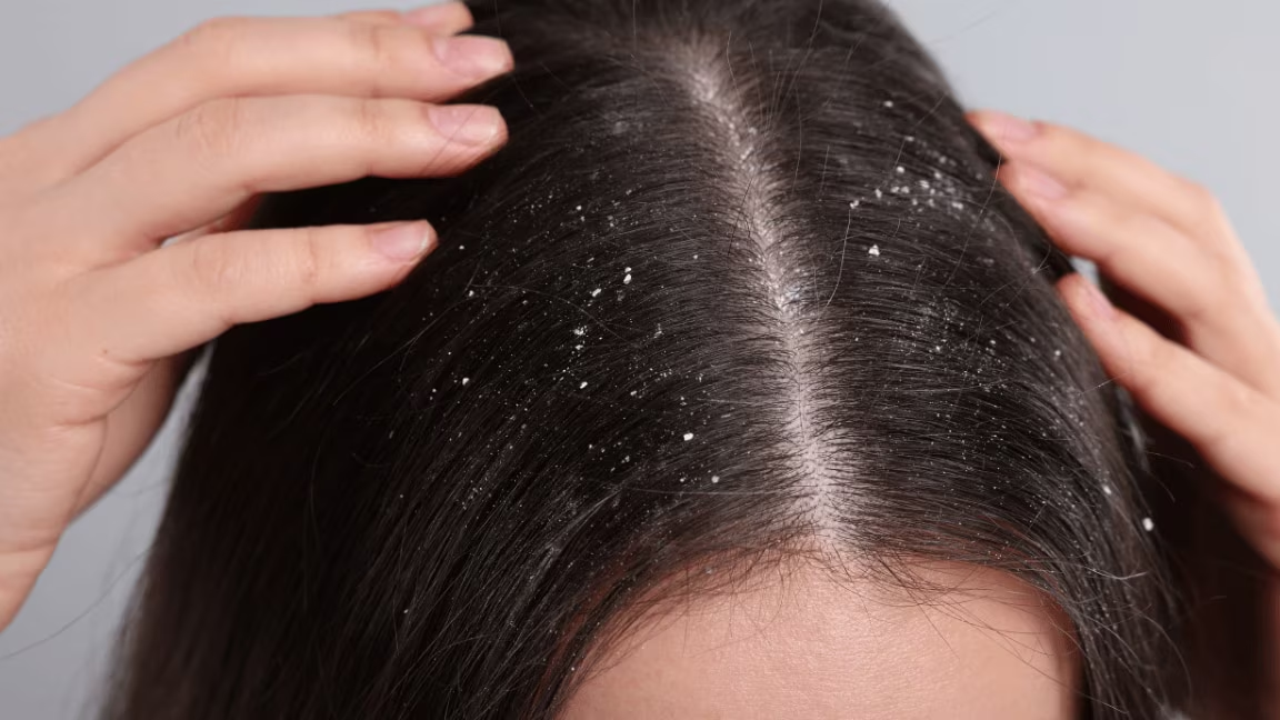 How to Regain Hair Loss Due to Dandruff: Your 3-Step Recovery Plan
