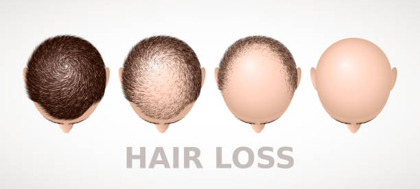 What Is Baldness Level 1? Norwood Scale Explained