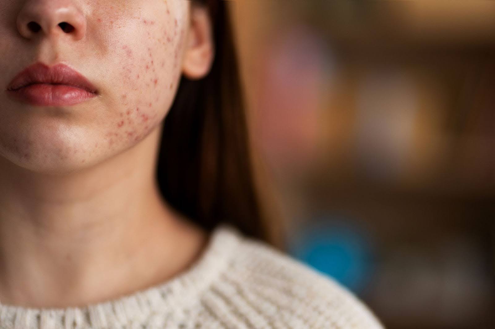 Understanding the 7 Types of Acne: Causes, Symptoms & Solutions