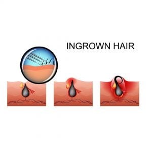 Issues With Ingrow Hair | Bodycraft