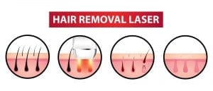 Hair Removal Laser