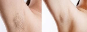 Laser Darker Hair Reduction