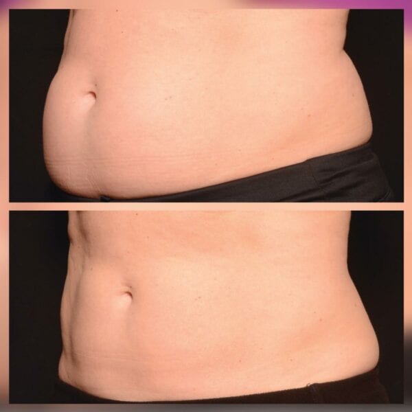 Coolsculpting: Before And After | Bodycraft