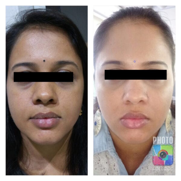 Affordable Pimple Mark Removal | Bodycraft