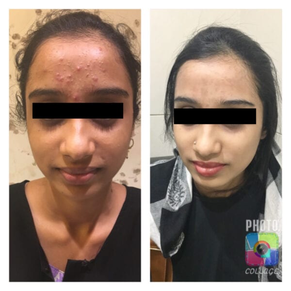 Pimple Mark Removal: Before & After | Bodycraft