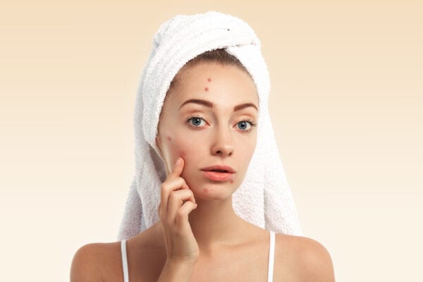 How To Get Rid Of Pimple Marks | Bodycraft