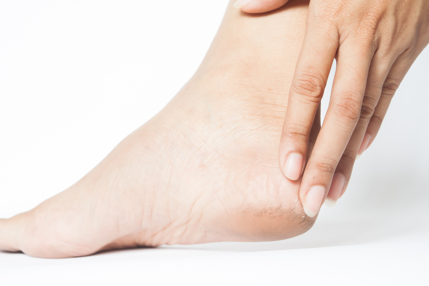 Cracked heel touch.